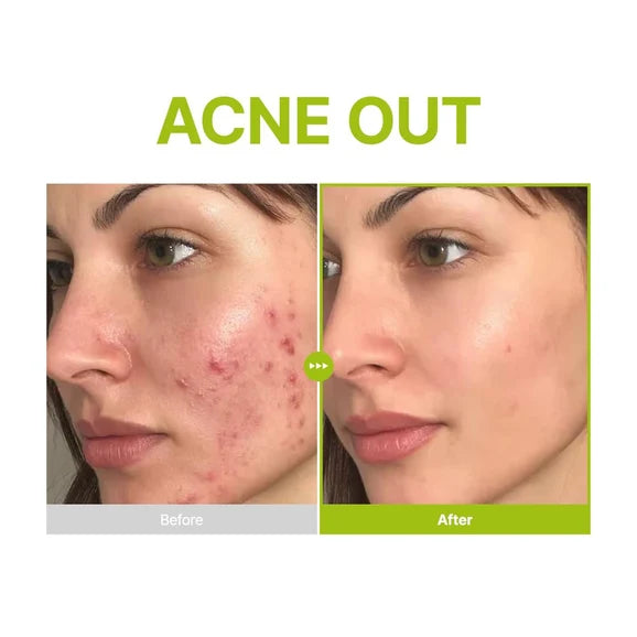 Purito Azelaic Acid 10 Kojic Tea Tree Serum 30ml